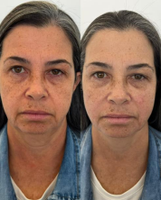 Antes e depois — Bioestimulador de Colágeno