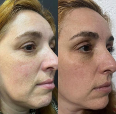 Antes e depois — Laser CO2