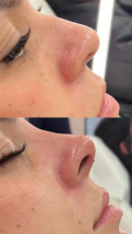 Antes e depois — Preenchimento